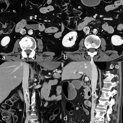 Vena Cava Filters: Toward Optimal Strategies for Filter Retrieval and Patients' Follow-Up